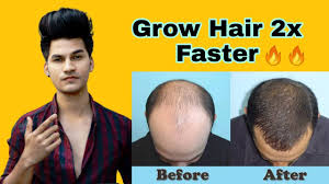 Amla or indian gooseberry is pretty much a miracle fruit. Grow Your Hair 2x Fast Best Hair Growth Oil In India 100 Effective Youtube