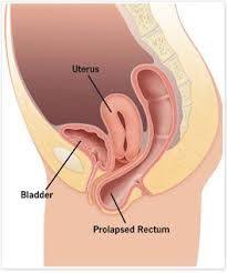Pin On Beckenboden Pelvic Floor