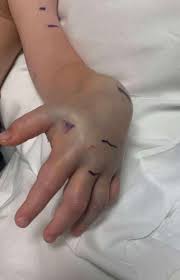 DAYCARE SNAKE BITE: A 4-year-old boy is in the hospital after a snake bit  him near his ring finger at daycare. A worker killed the copperhead after  the attack. The family says