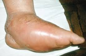 Zdjęcia późnych powikłań ku przestrodze. Stopa Cukrzycowa Cukrzyca Medycyna Praktyczna Dla Pacjentow