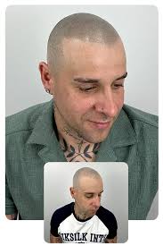 Oscar Arango Micropigmentación capilar