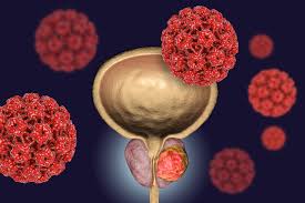 Certain factors can increase the risk of prostate cancer. Integrating Parp Inhibitors Into Advanced Prostate Cancer Therapeutics