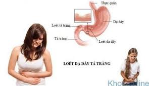 Gastroesophageal reflux disease) còn được gọi là bệnh trào ngược axit dạ dày, là tình trạng trào ngược từng lúc hay thường xuyên của dịch dạ dày lên thực quản.một khi triệu chứng trào ngược lặp lại và gây ra khó chịu hoặc biến chứng thì mới gọi là bệnh trào. Phong Tranh Ä'au Dáº¡ Day Nhá» Cháº¿ Ä'á»™ Äƒn Há»£p Ly