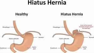 Image result for stomach hernia symptoms
