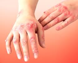 Image result for psoriasis