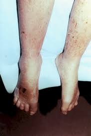 Complex Regional Pain Syndrome Symptoms Diagnosis And Treatment Bmj Best Practice Us