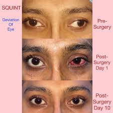 Image result for Eye Deviation