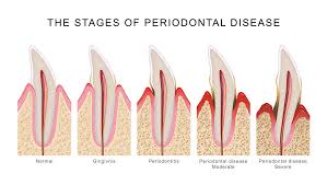 Image result for Periodontitis