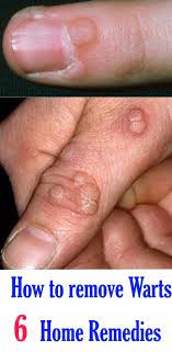 How To Remove Warts 6 Home Remedies Home Remedies For Warts Warts Remedy Natural Home Remedies