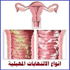 امراض المهبل بالصور كلام للسيدات فقط اعتذار و اسف