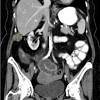 How is bowel cancer diagnosed? 1