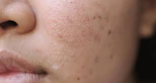 Cara menghilangkan jerawat buta secara alami ini sangat ampuh dan patut anda coba untuk menyingkirkan jerawat buta yang anda alami. Cara Menghilangkan Parut Jerawat Encikshino Com