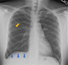 Ventriculopleural Shunt Radiology Case Radiopaedia Org