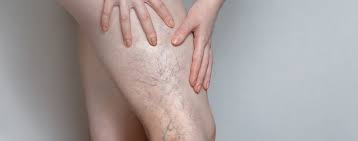 Thrombose Anzeichen Und Thromboseprophylaxe Focus Arztsuche