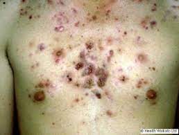We did not find results for: Nodulocystic Acne Dermnet Nz