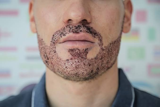 Beard Hair Transplant in Mumbai and Raipur | Reshape Your Beard
