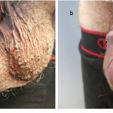 'an infection is one of the complications that can occur after having. Scrotal Alopecia And Scrotal Laxity In A 93 Year Old Man Distant A And Download Scientific Diagram