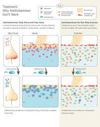 Antihistamines Help Hives And Hay Fever But They Do Not Help Eczema Credit Niaid Eczema Atopic Dermatitis Eczema Help