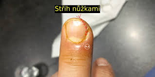 Image result for Akutní zánět nehtového lůžka