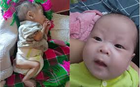 Hơn 230.000 trẻ suy dinh dưỡng cấp tính nặng nhưng chỉ gần 1% được điều trị