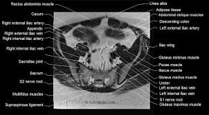 The levator ani has three main components, each of which is paired 1,2,5: Female Pelvis Anatomy Free Axial Cross Sectional Anatomy Of Female Pelvis