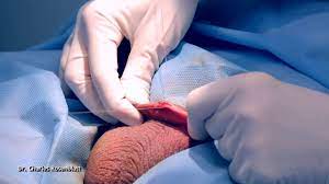 Vasectomy is an effective form of birth control, but it won't protect you or your partner from sexually transmitted infections, such as chlamydia or hiv/aids. Vasectomia Em 01 Minuto Youtube