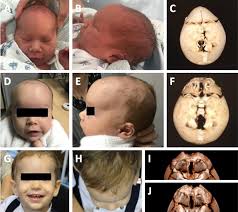 Neonate with metopic synostosis who was operated