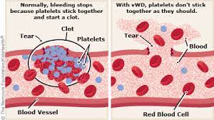 Von Willebrand Disease