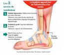 Tendinite du tendon daposAchille