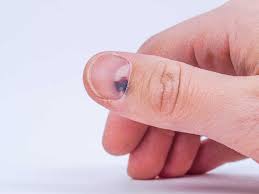 Bluterguss Unter Dem Finger Oder Zehennagel Was Hilft