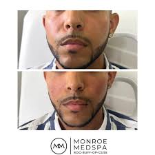 truSculpt iD before and after. We are fighting the good fight with the  COVID-19 (or 10 or 30 :) using our truSculpt iD! How does TruSculpt iD  work? It works by heating