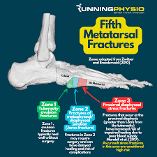 Image result for Metatarsal