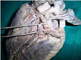 Ijcap Indian Journal Of Clinical Anatomy And Physiology Ip Innovative Publication Pvt Ltd