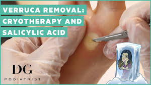 Considering that a body pillow is much bigger than a typical pillow, it can be quite confusing and leave you wondering how to wash a body pillow and if it. Verruca Removal Cryotherapy And Salicylic Acid Youtube