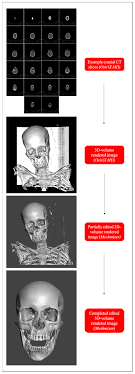 Population-Inclusive Assigned-Sex-at-Birth Estimation from Skull Computed  Tomography Scans