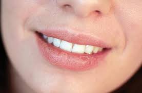 Tahukah anda bibir kering mengelupas bukan disebabkan kerana kekurangan air. Bibir Pecah Pecah Punca Dan Rawatan