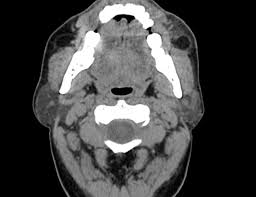 Image result for Sialolithiasis