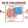 The term sickle cell disease is preferred to sickle cell anemia for the name of the condition, not least because the former term reflects the fact that the condition sickle cell disease is known to have a wide spectrum of clinical presentations from completely asymptomatic to a severe overwhelming crisis. Https Encrypted Tbn0 Gstatic Com Images Q Tbn And9gctajtgzvbxmdvgyes1h9r467wgrbpf85ixophdplz2q5prqeoiu Usqp Cau