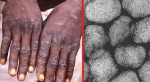 Smallpox is an ancient disease caused by the variola virus. Vaiolo Delle Scimmie L Allerta Del Virologo Malattia Grave Morte In Un Paziente Su 5