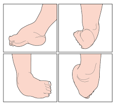 La séance se passe plutôt bien, avec l'espoir certain d'avoir amélioré le schéma de fonctionnement global de cette gentille poulichette.répondu à la problématique initiale? Pied Bot Causes Traitements Operation