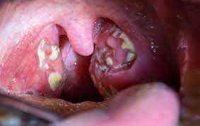 Image result for Tonsillitis