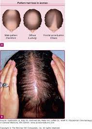 The mites may also be found on other parts of the body, such as the chest and buttocks. Hair Growth Disorders Plastic Surgery Key