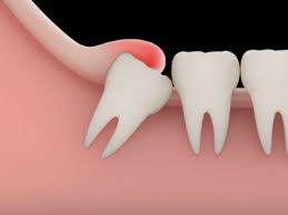 Ways to pull a tooth. 3 Ways To Extract Teeth Not All Of Them Recommended