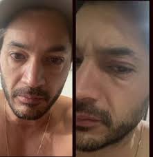 Daniel Elbittar muestra cómo quedó su rostro tras intoxicarse