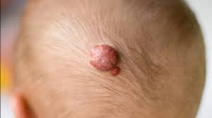 There are a number of different treatments doctors recommend. Hemangioma Symptoms Diagnosis And Treatment