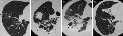 Mycobacterium Avium Complex Disease Prognostic Implication Of High Resolution Computed Tomography Findings European Respiratory Society