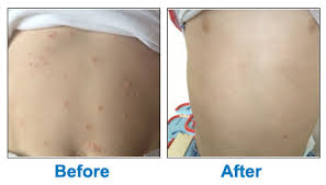 Maybe you would like to learn more about one of these? Zymaderm Molluscum Contagiosum Treatment Naturopathix