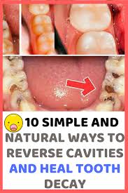 How to reverse tooth decay naturally. How To Reverse Tooth Decay Ayurveda Arxiusarquitectura