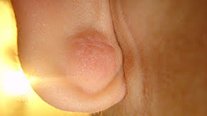 Do you need to get serious about it? Earlobe Cyst Causes Treatments And More