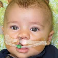 NAM Appliances for Cleft Palate